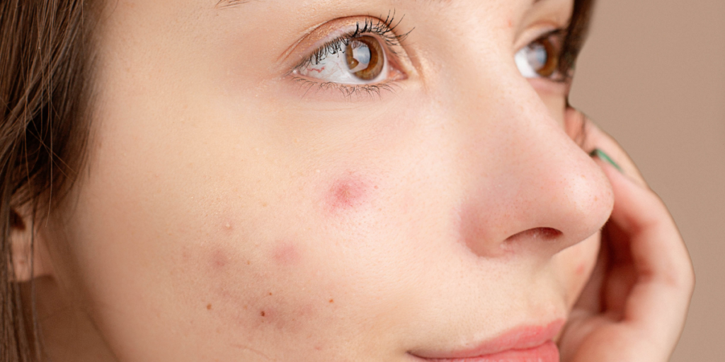 5 Symptoms Of Corn Intolerance What You Should Know Gut Advisor